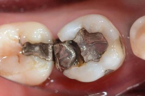 ۳ روش پر کردن دندان شکسته که باید بدانید